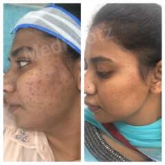skin treatment 