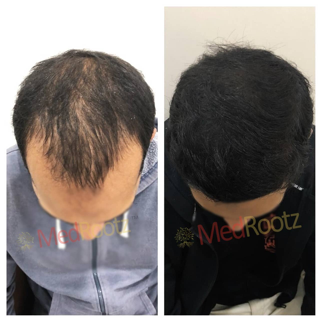 Minoxidil