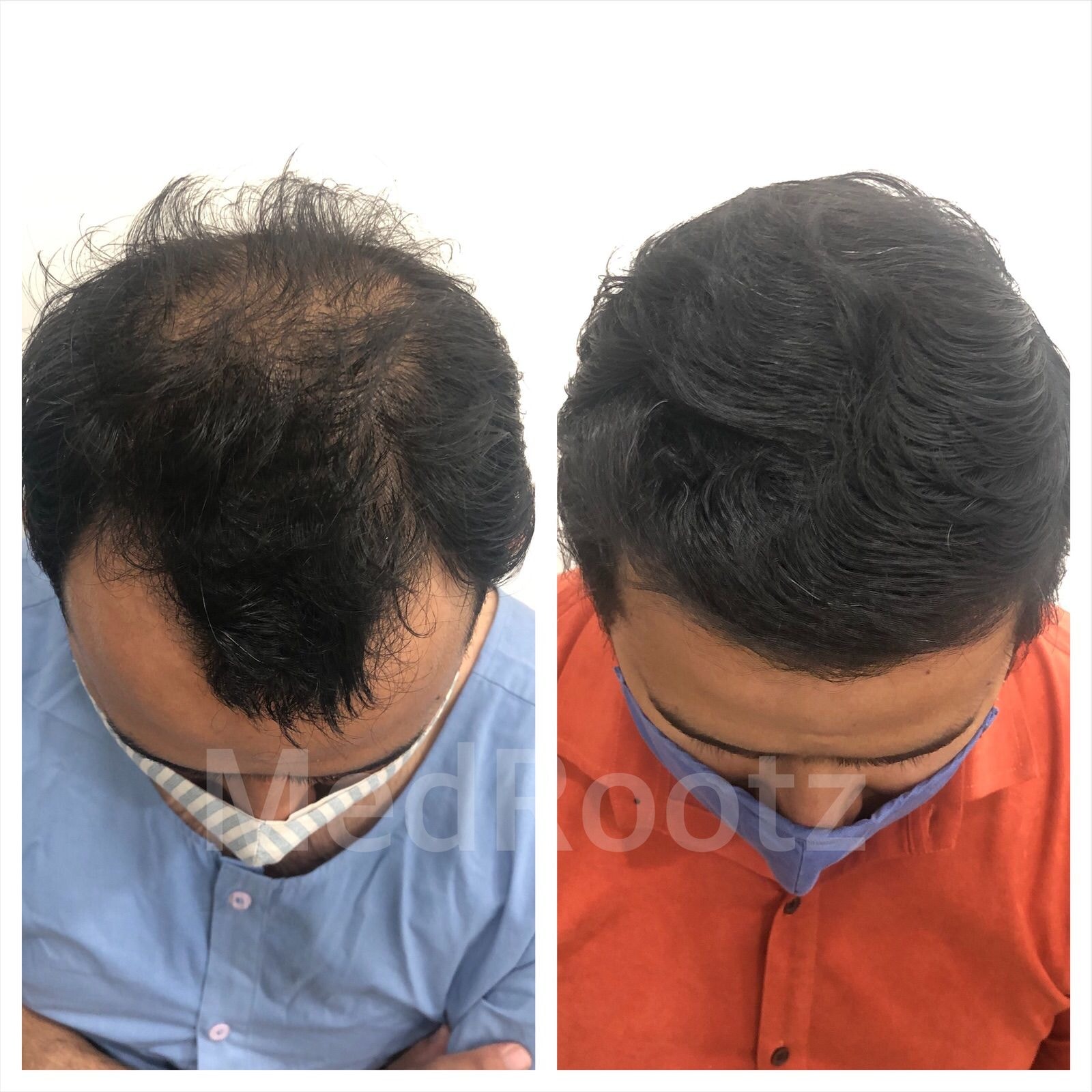 Moustache Restoration