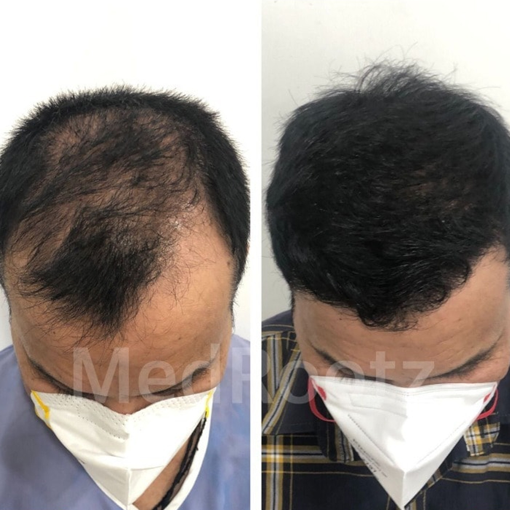 Hair Transplant