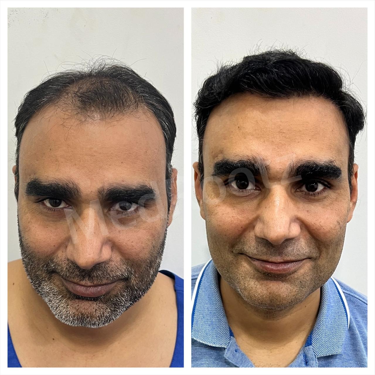 Best hair transplant in India