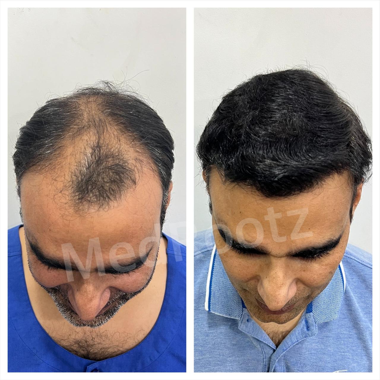 Best hair transplant in India