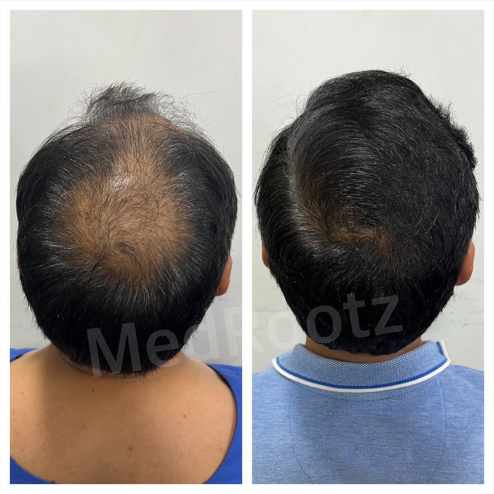 Best hair transplant in India