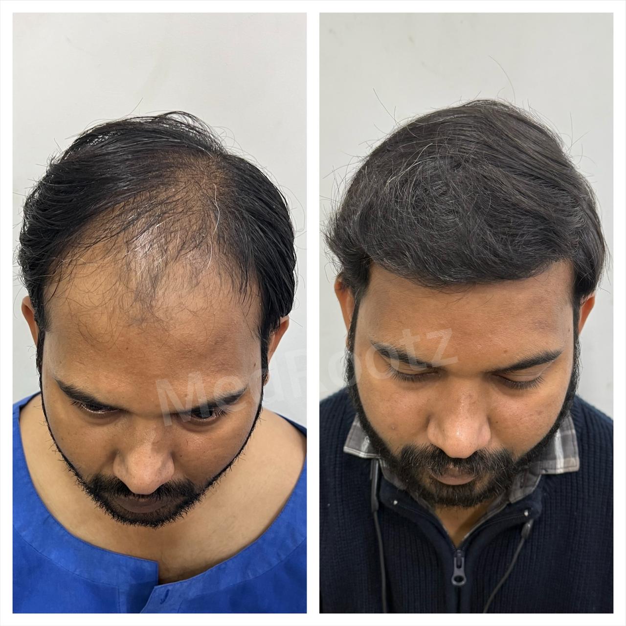 Best hair transplant in India