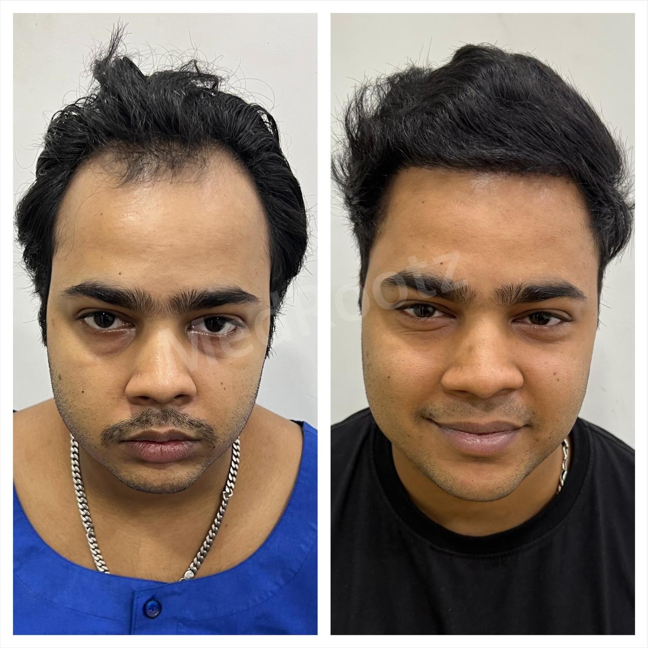 Best hair transplant in India