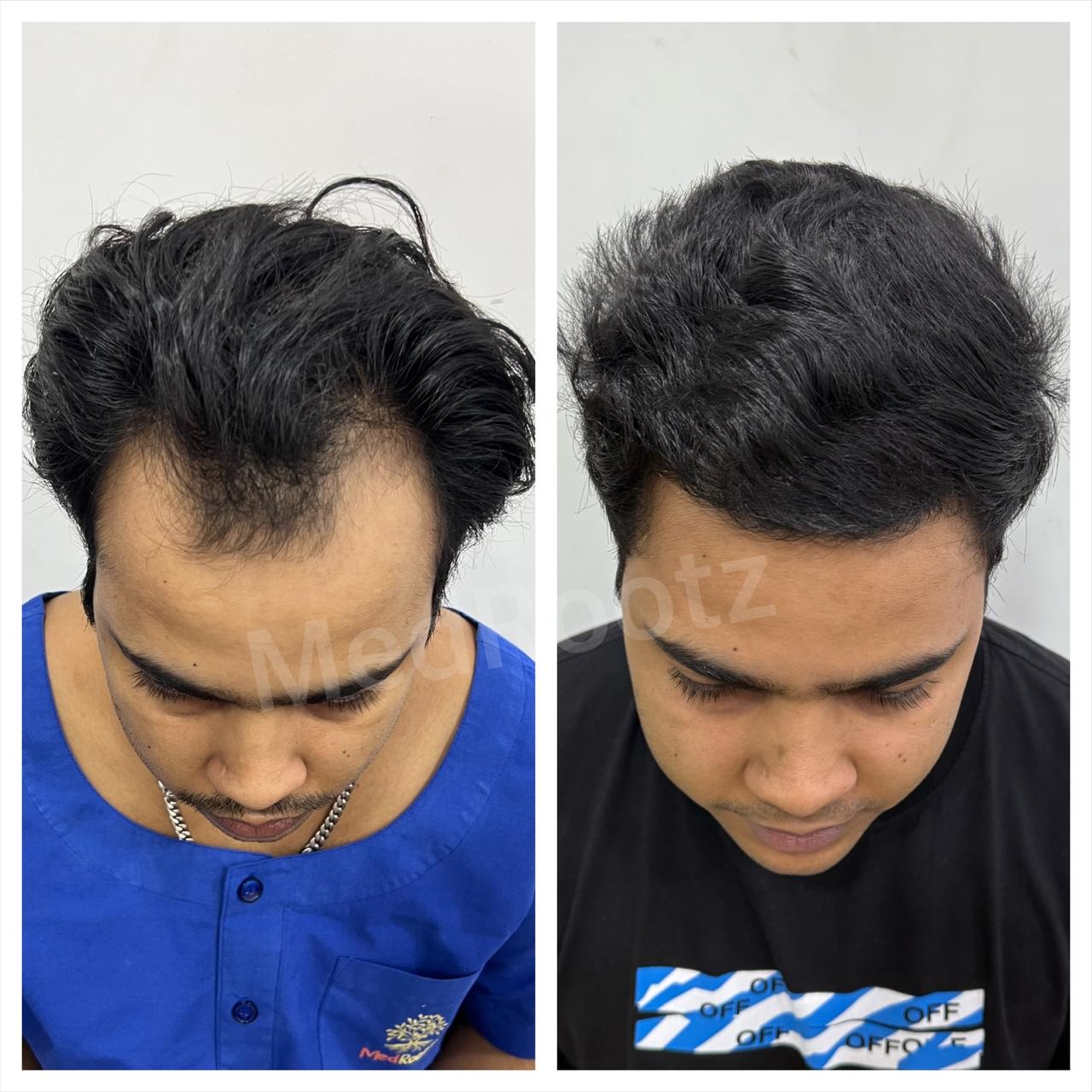 Best hair transplant in India