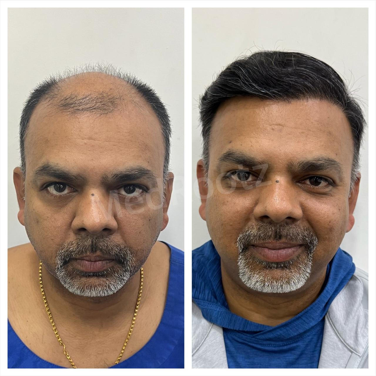 Best hair transplant in India