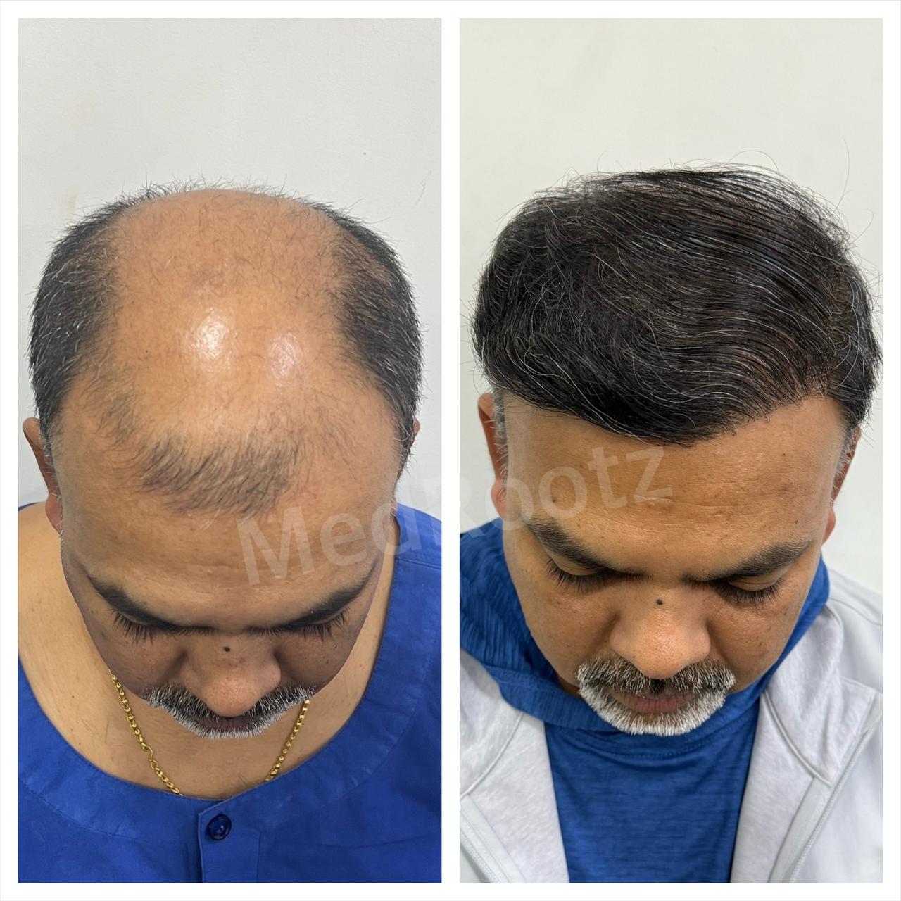 Best hair transplant in India