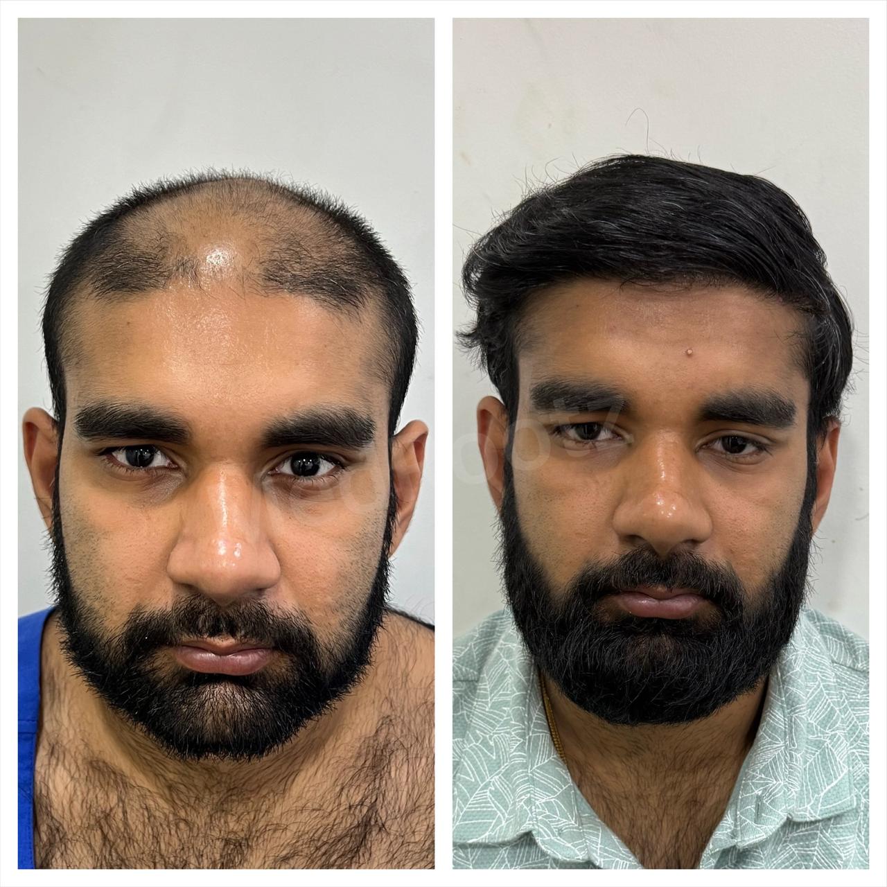 Best hair transplant in India
