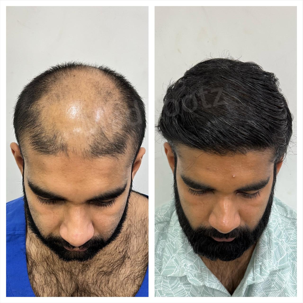 Best hair transplant in India