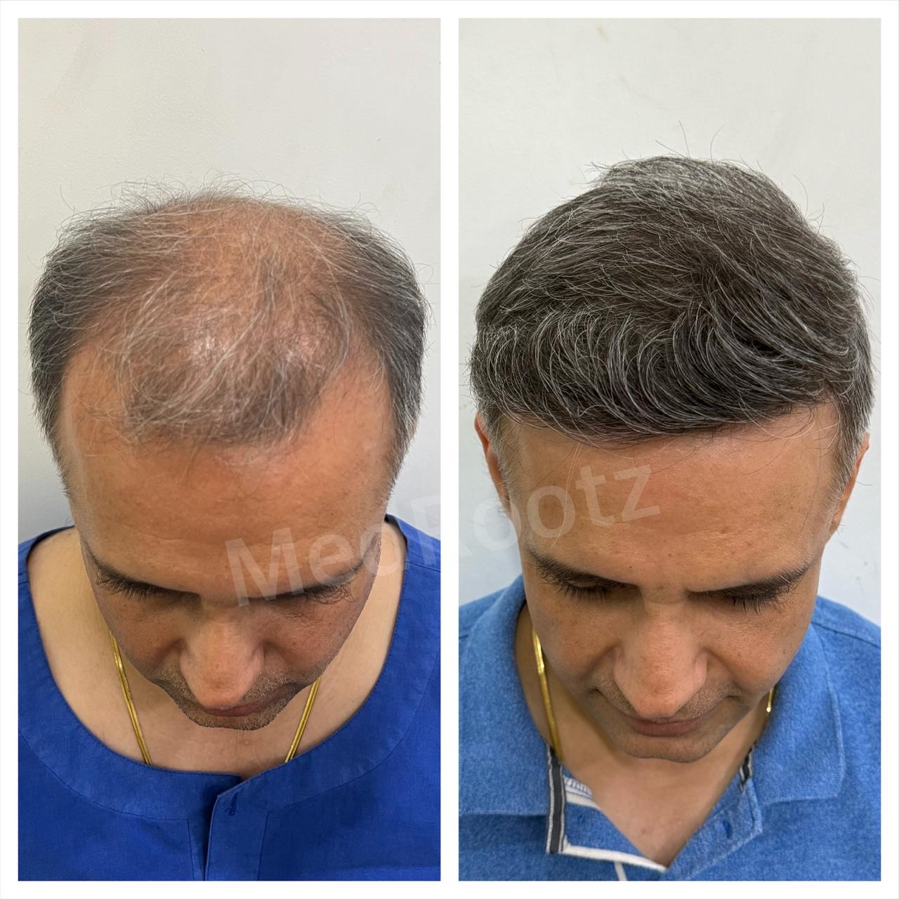 Best hair transplant in India
