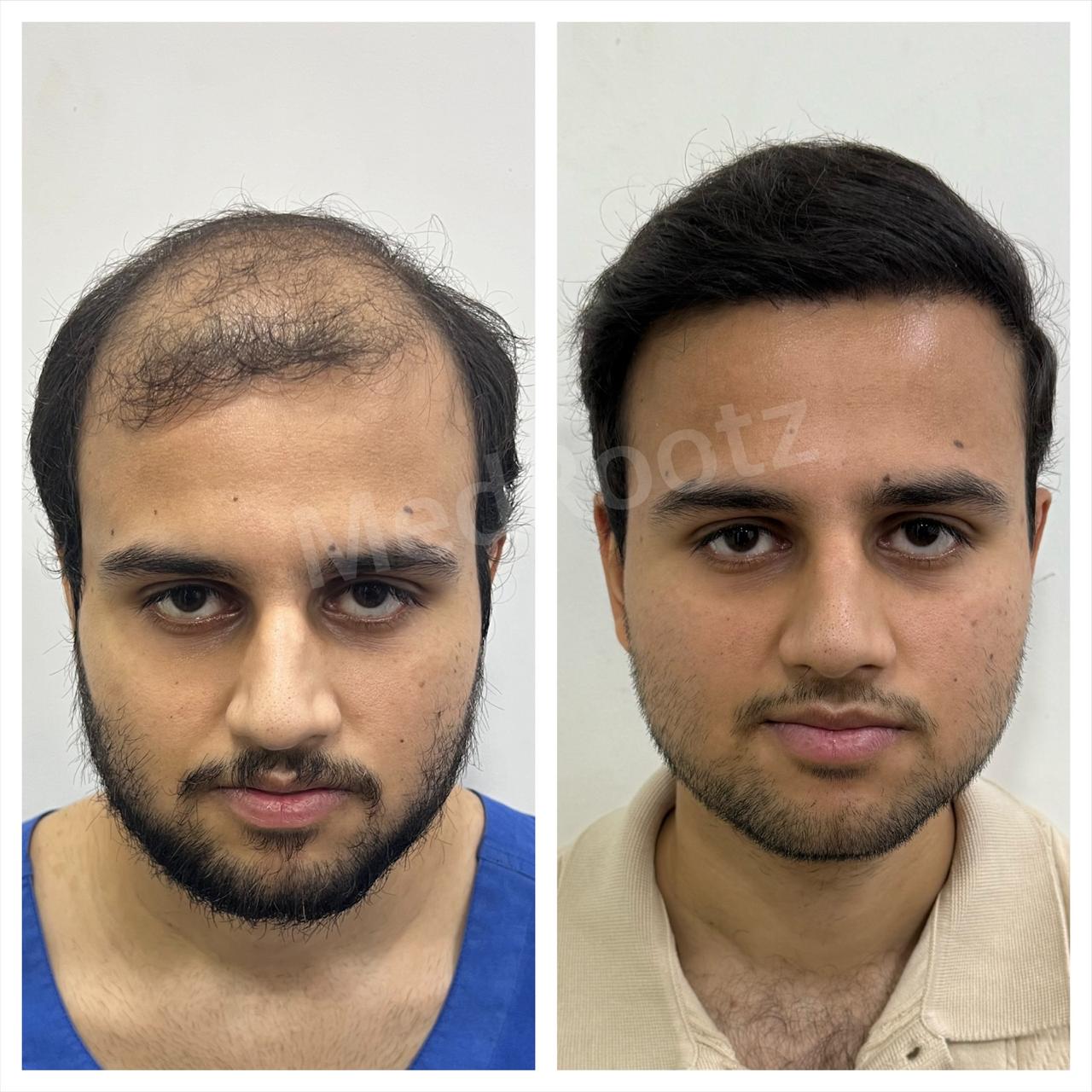 Best hair transplant in India