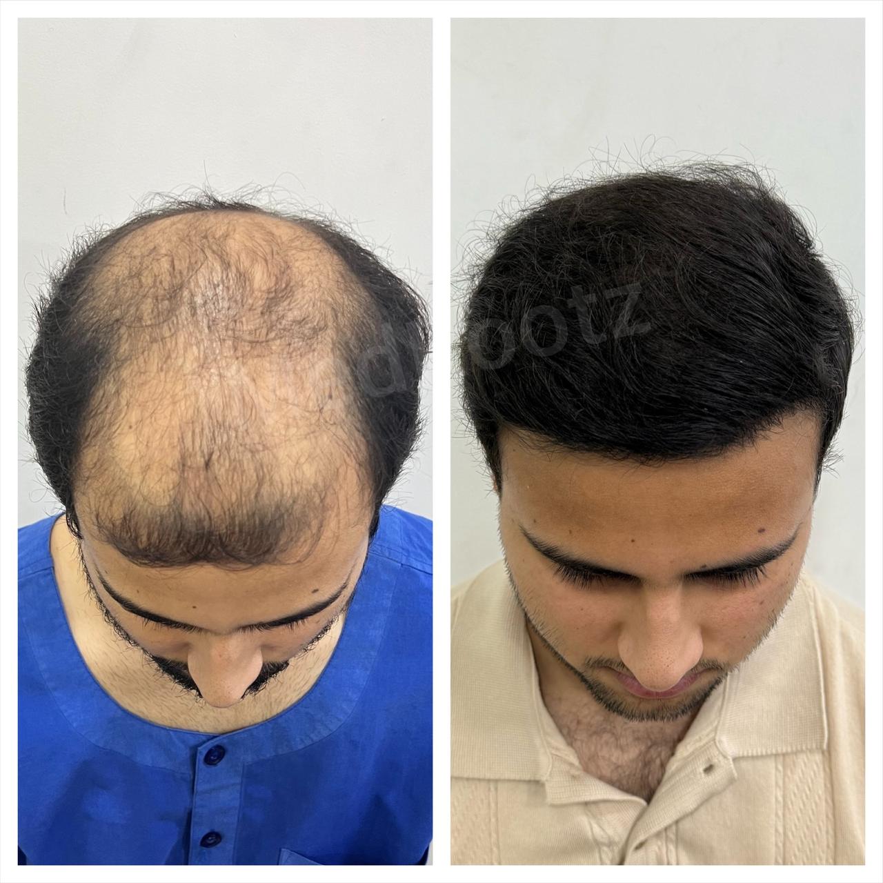 Best hair transplant in India
