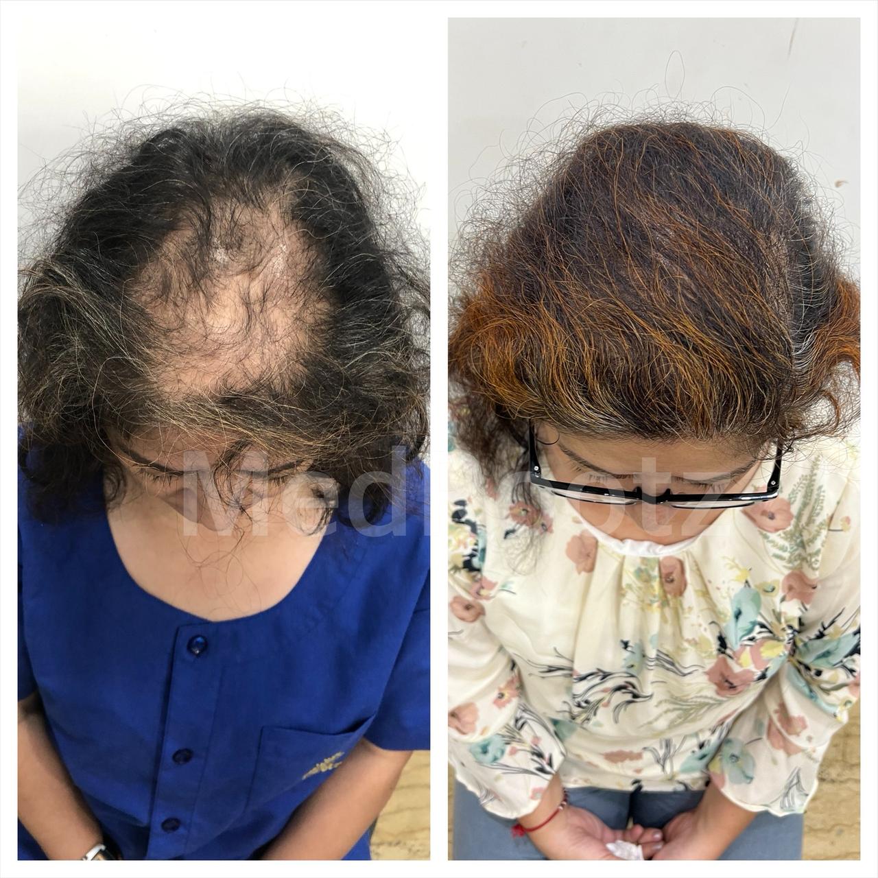 Best hair transplant in India