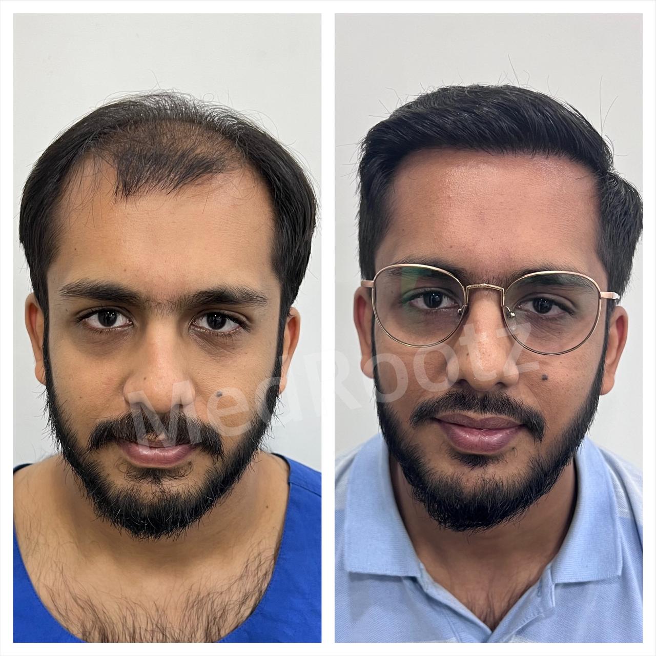 Best hair transplant in India