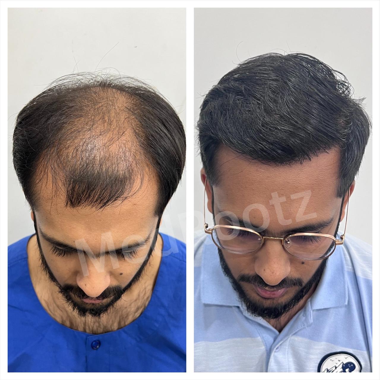 Best hair transplant in India