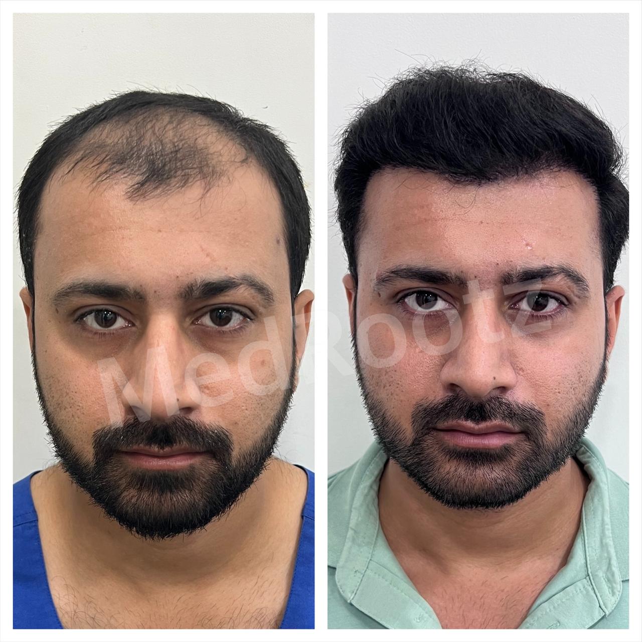 Best hair transplant in India