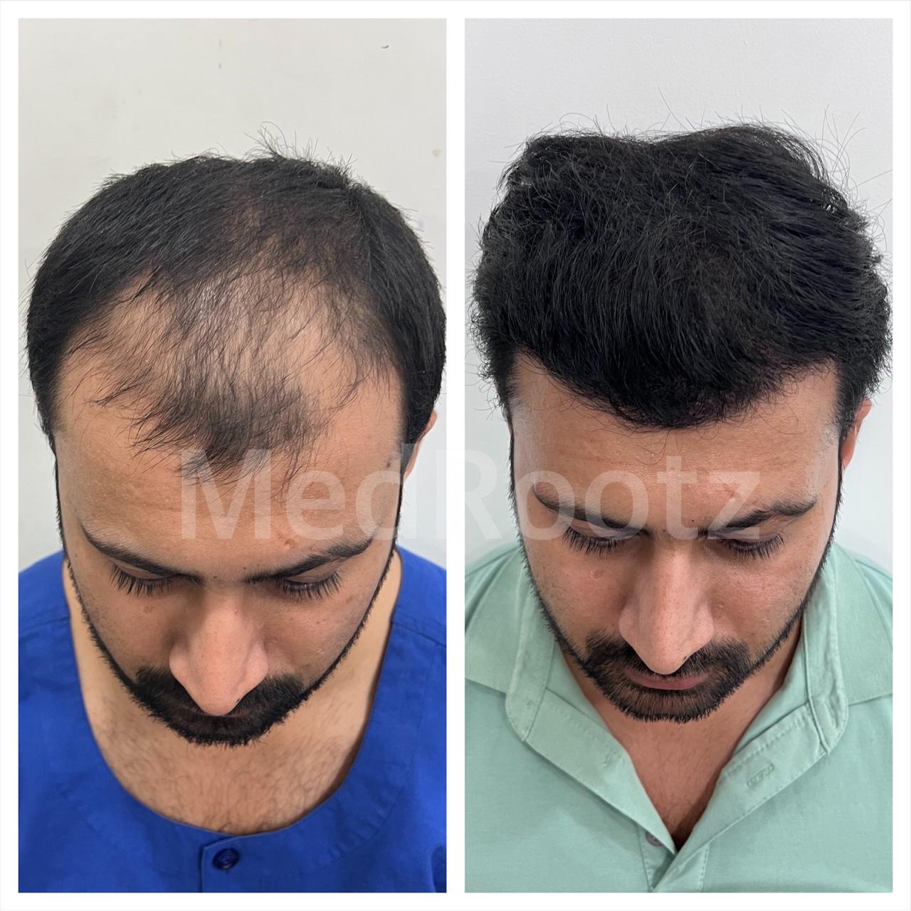 Best hair transplant in India