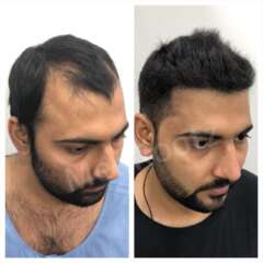 best hair transplant doctor new delhi