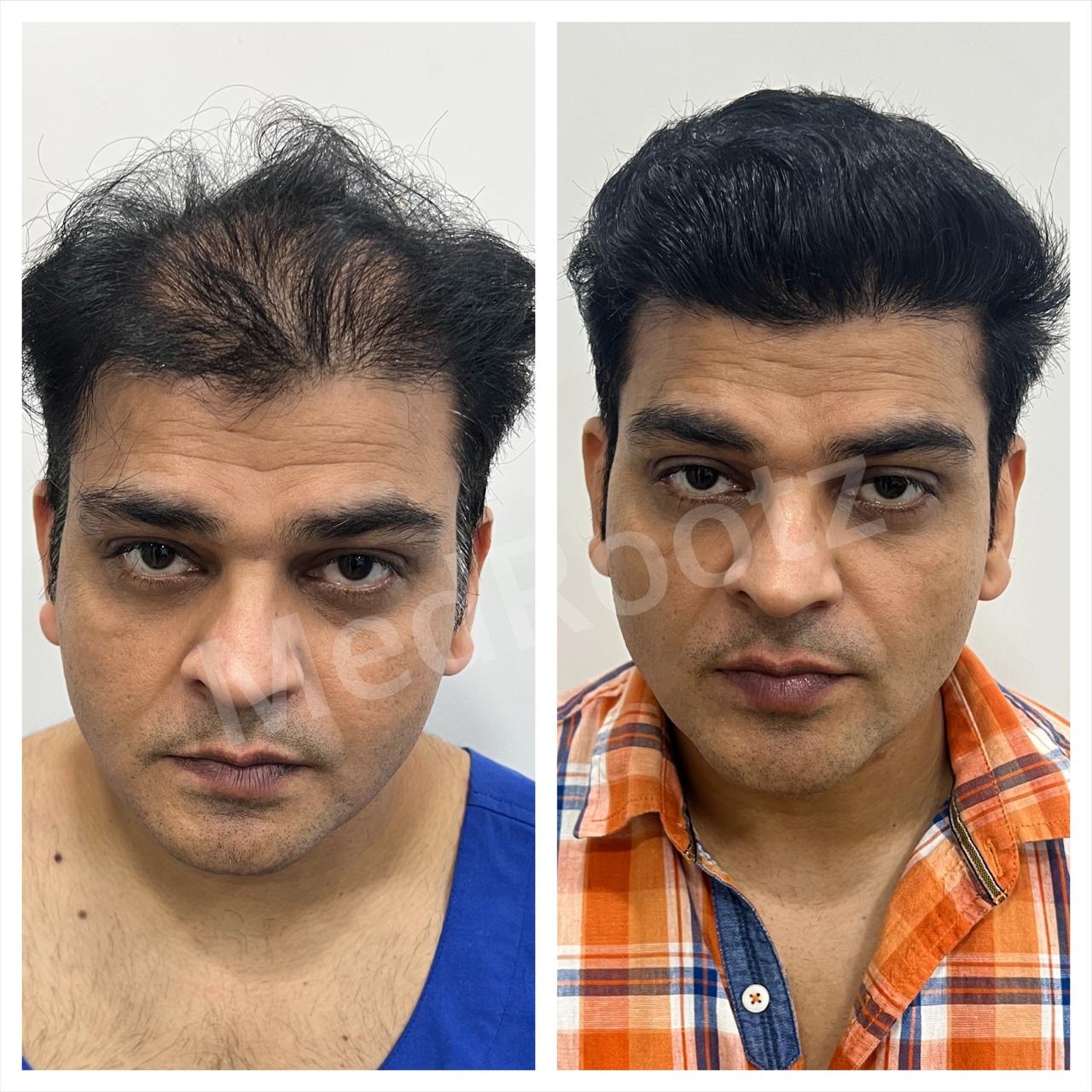 Best hair transplant in India
