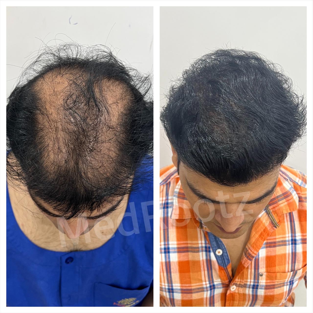 Best hair transplant in India