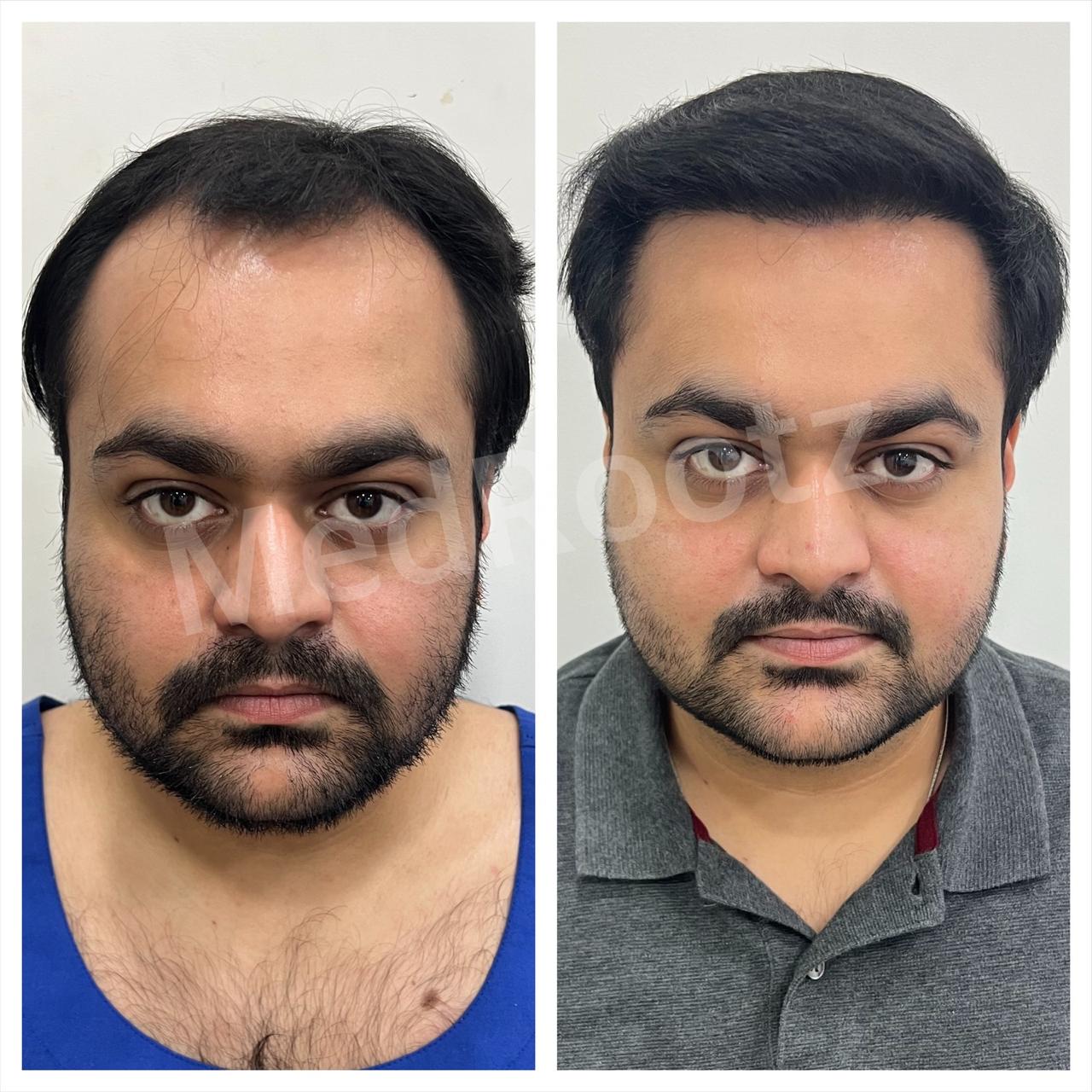Best hair transplant in India
