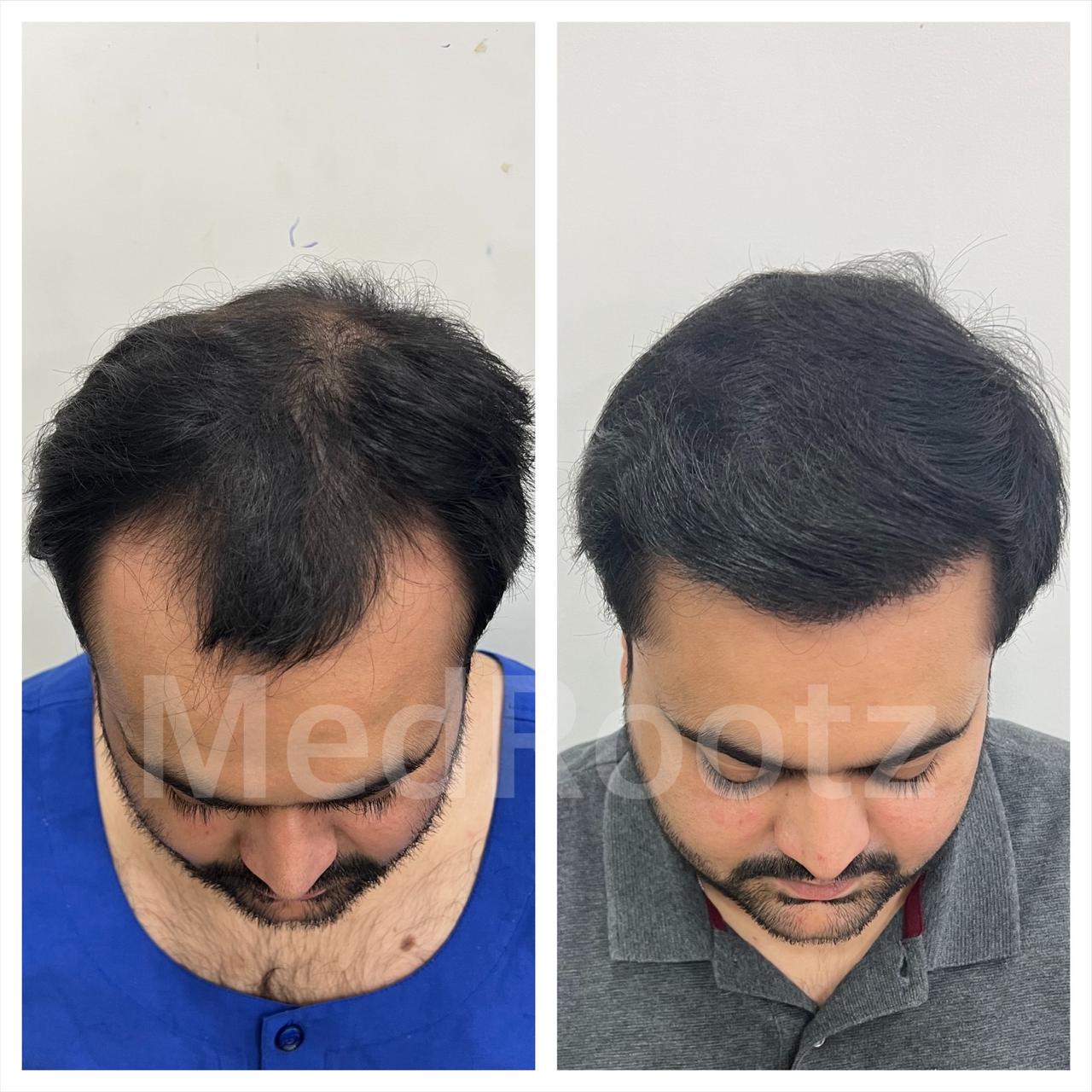 Best hair transplant in India