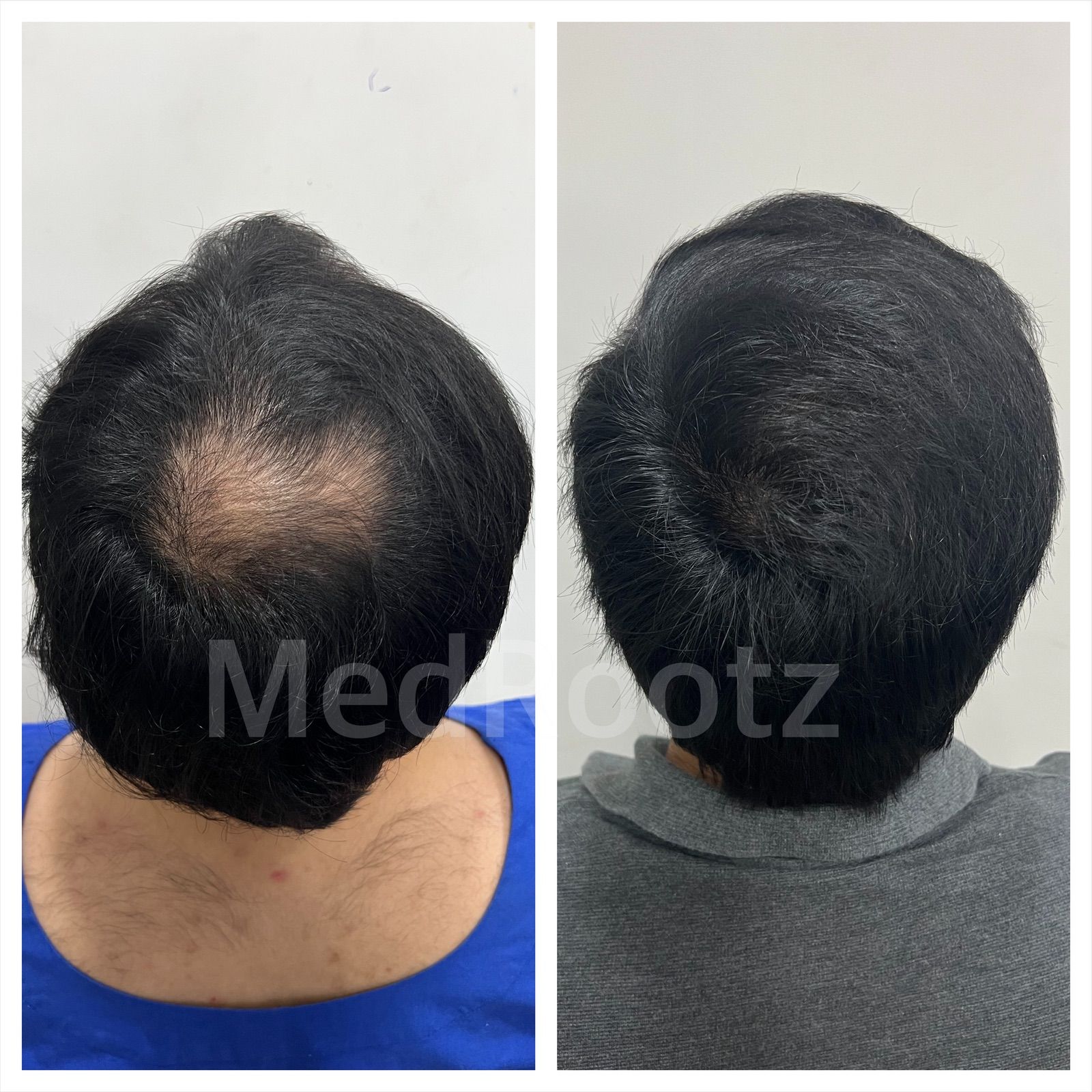 Best hair transplant in India