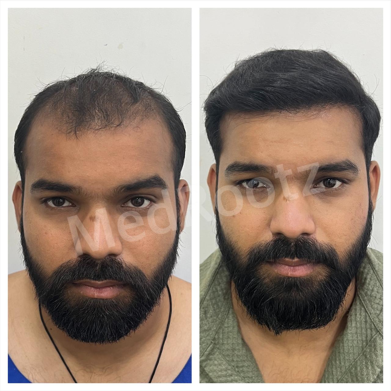 Best hair transplant in India