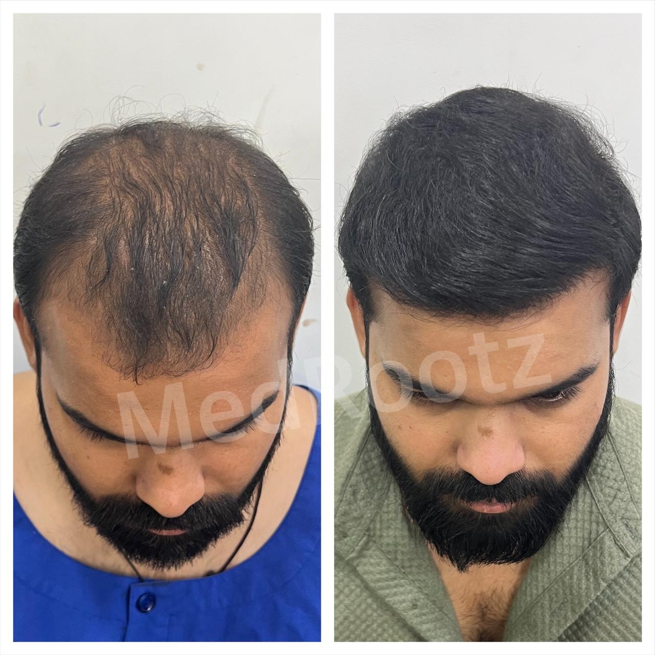 Best hair transplant in India