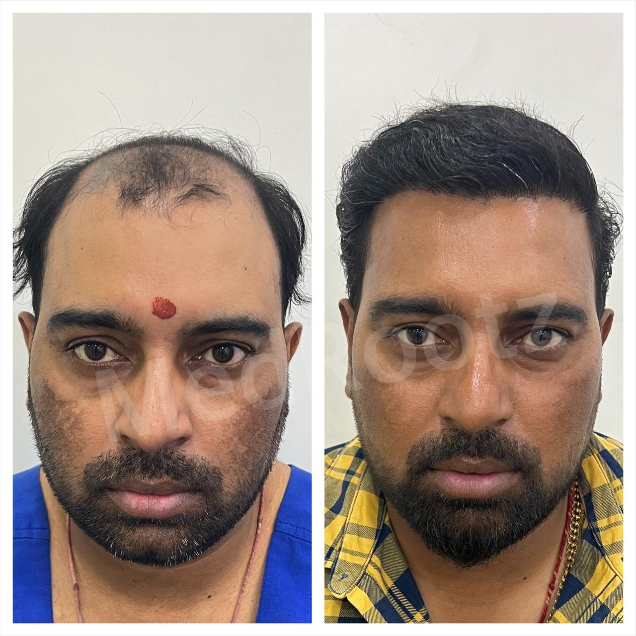 Best hair transplant in India