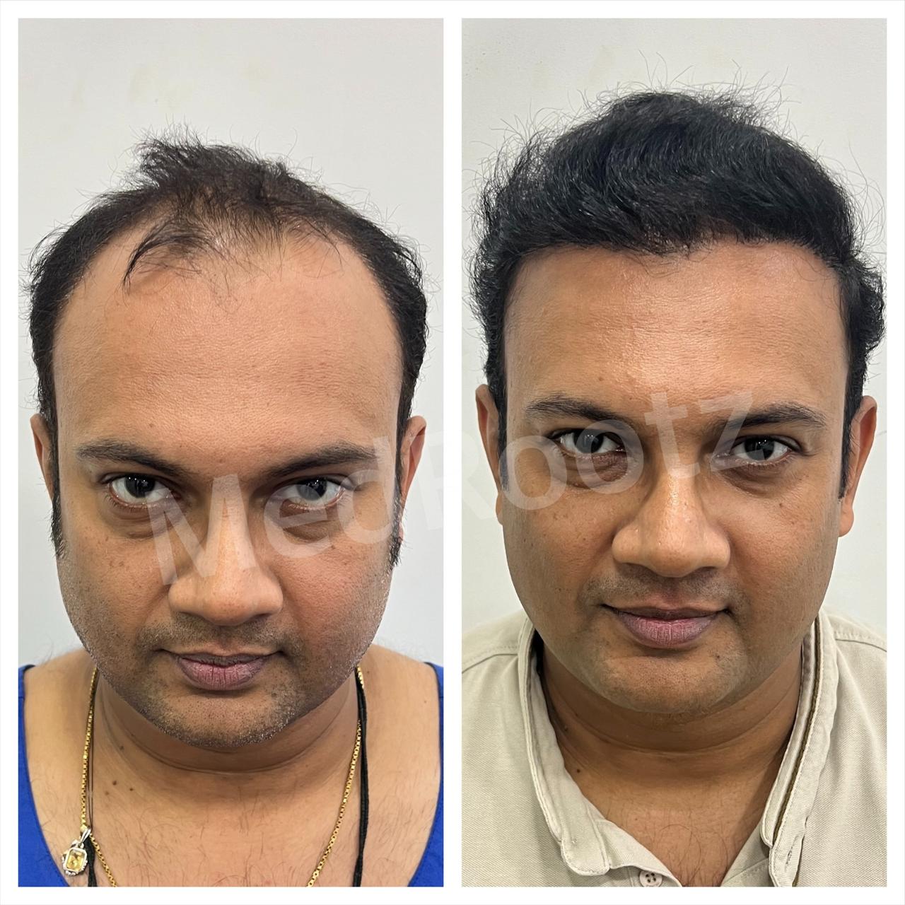 Best hair transplant in India