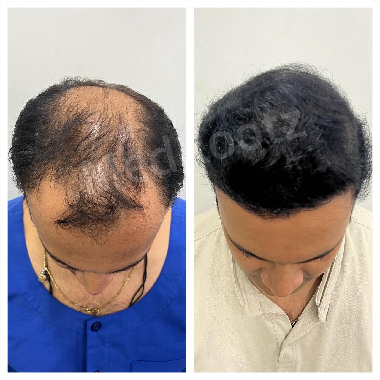 Best hair transplant in India