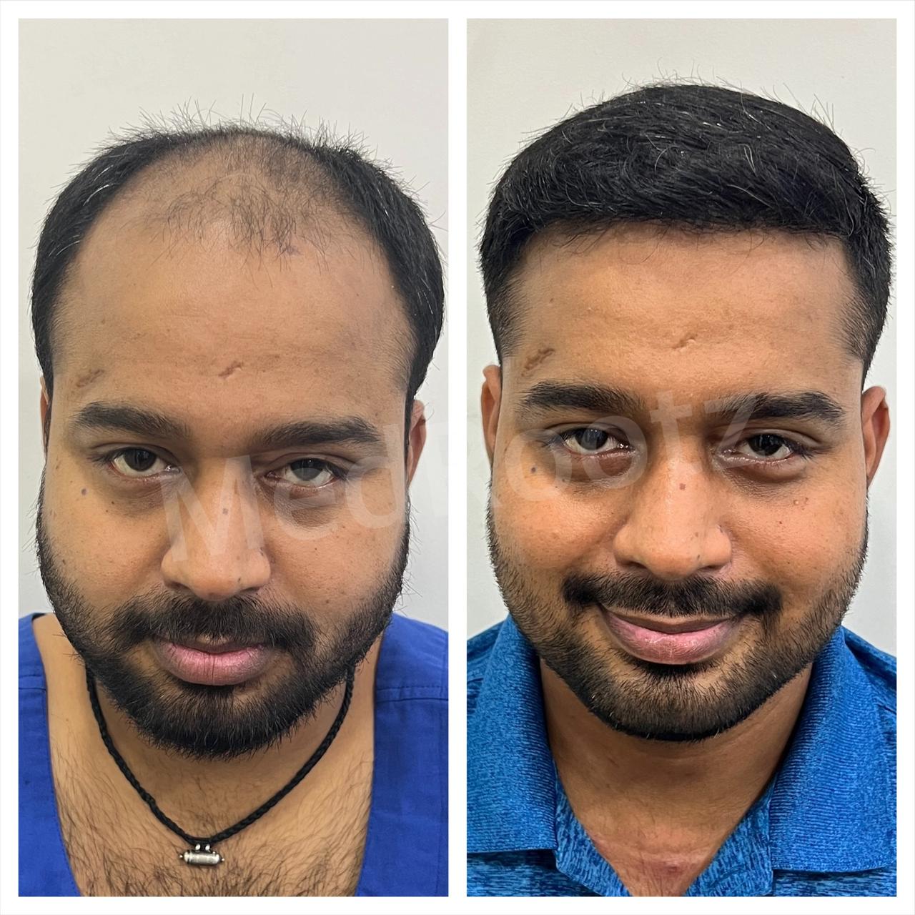 Best hair transplant in India