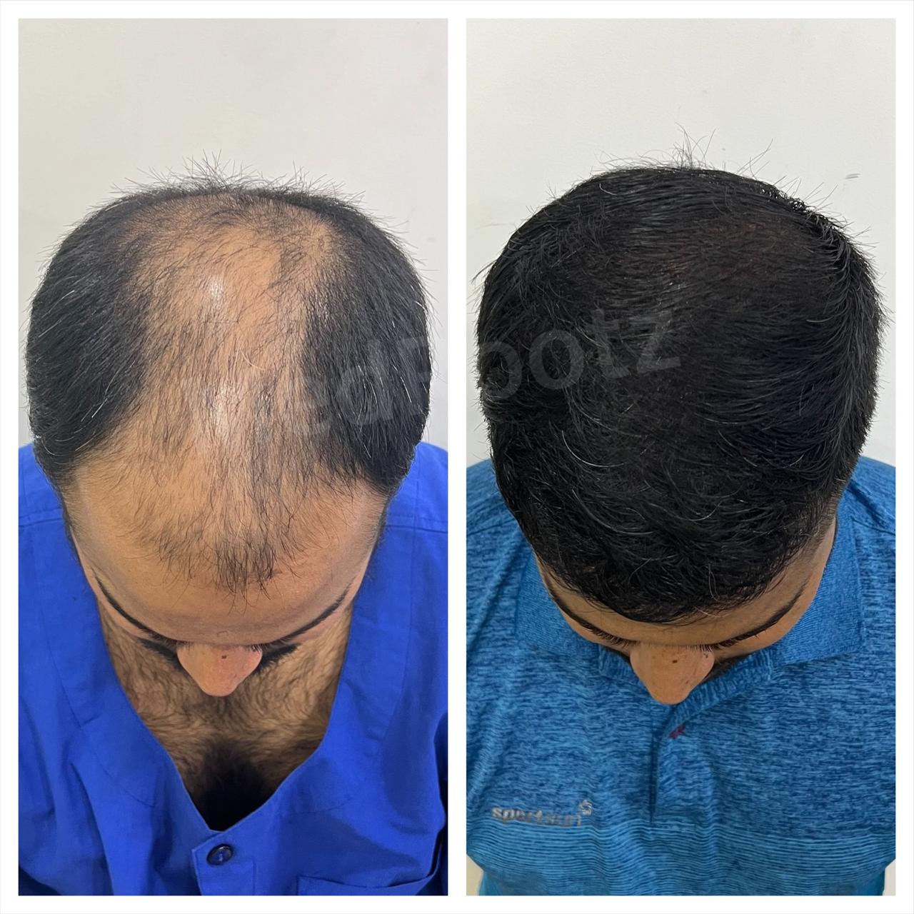 Best hair transplant in India