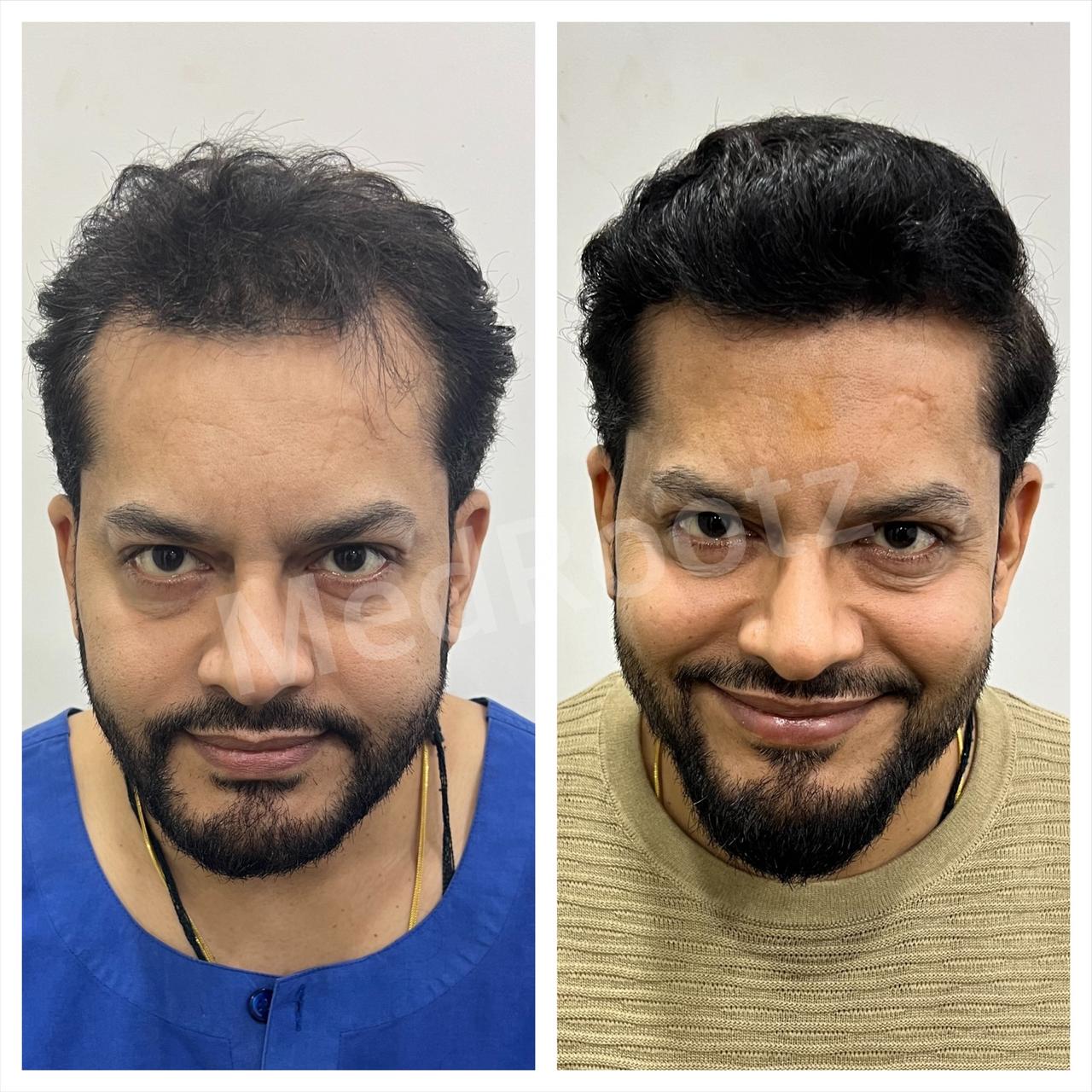 Best hair transplant in India