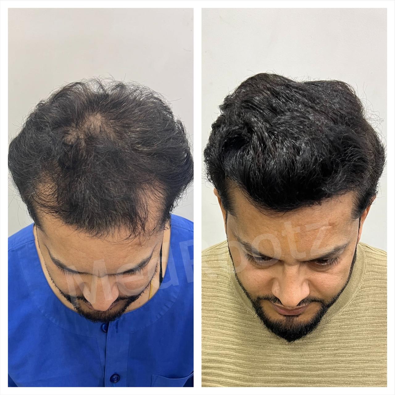 Best hair transplant in India