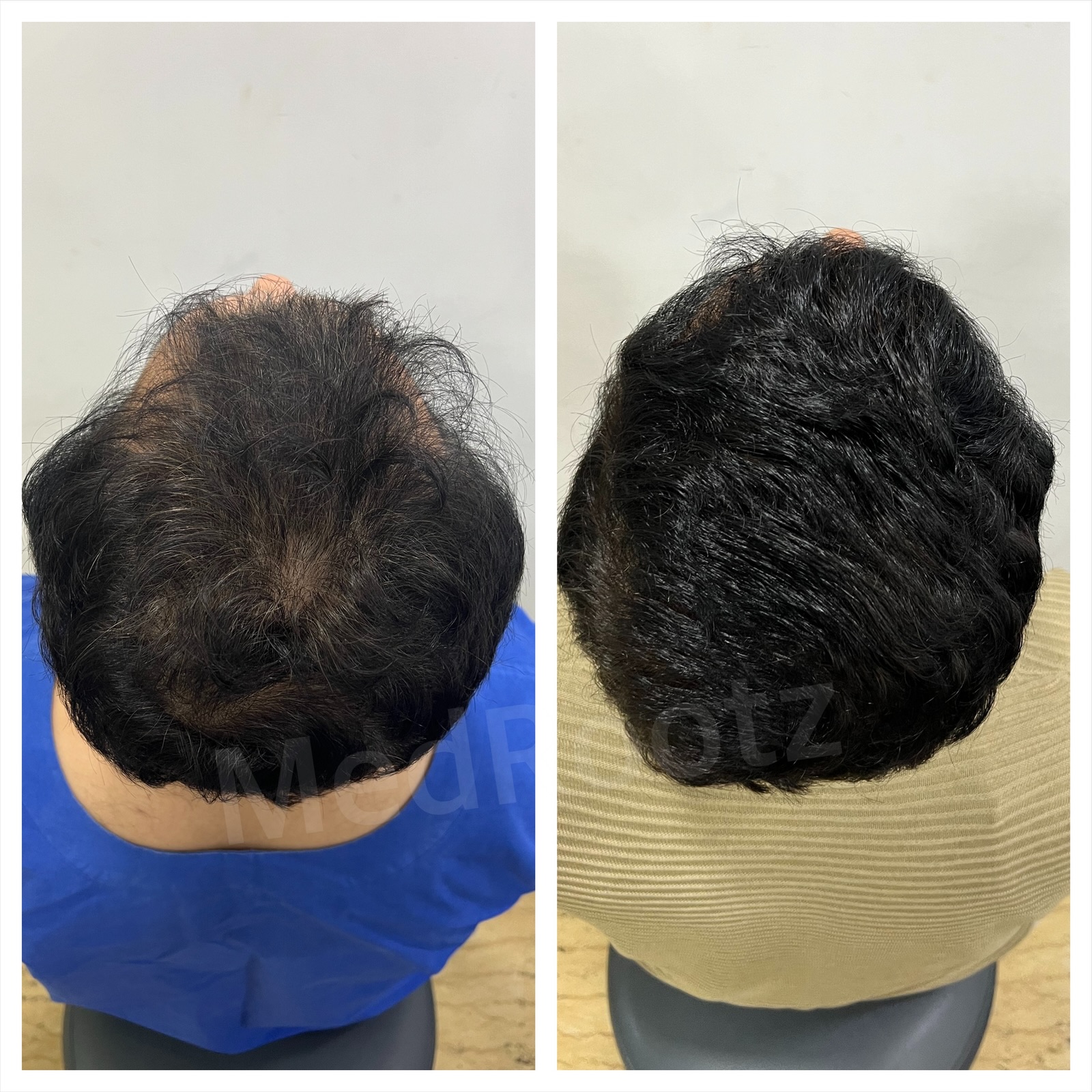 Best hair transplant in India