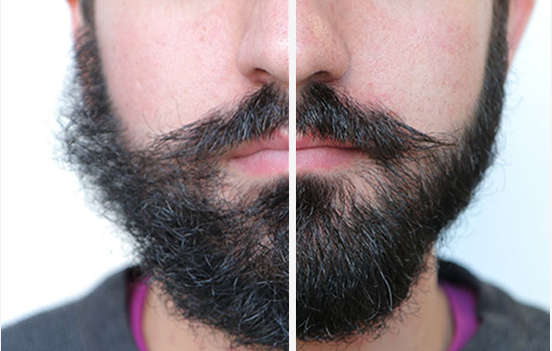 Beard Shaping Laser