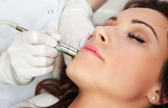 Carbon Photofacial Treatment