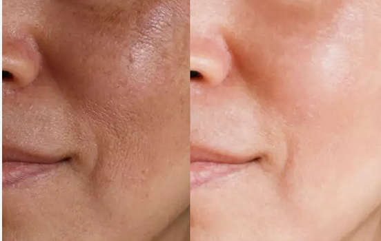 Pore Clear Facial