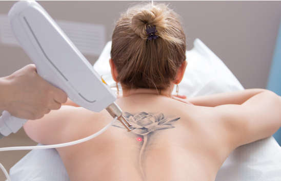 Tattoo Removal Clinic in Delhi