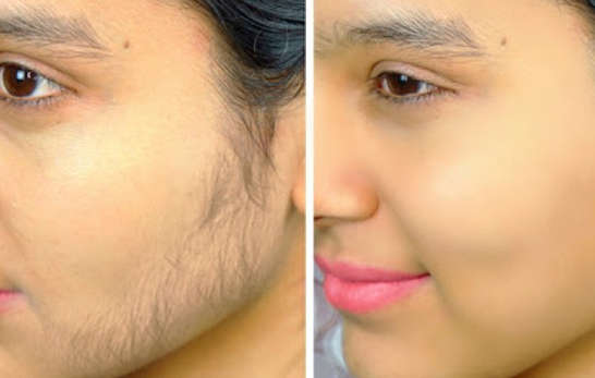 Unwanted Facial Hair Treatment