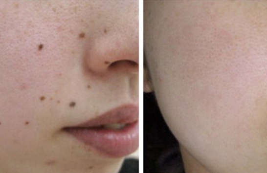 Lift Minus Stitch Facial