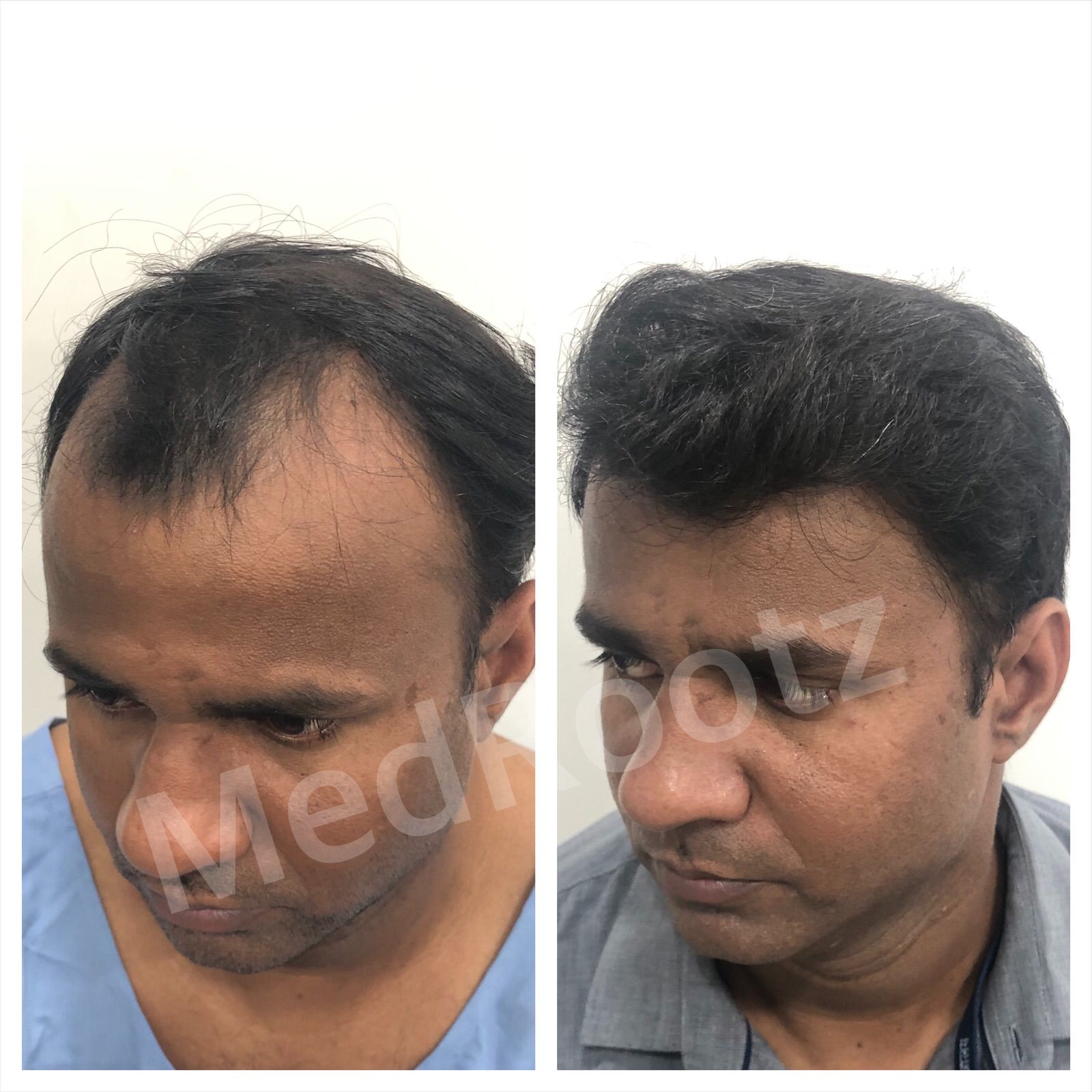 Best Hair Transplant Clinic in Delhi - MedRootz