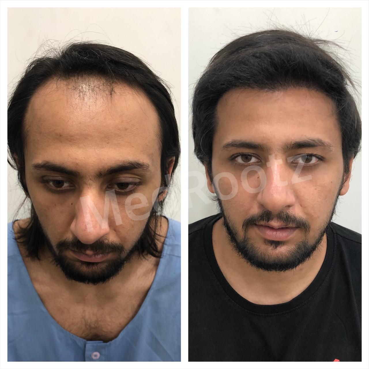 Best Hair Transplant in Delhi, India at the Best Hair Clinic in Delhi - MedRootz Best Hair Transplant in Delhi, India at the Best Hair Clinic in Delhi - MedRootz