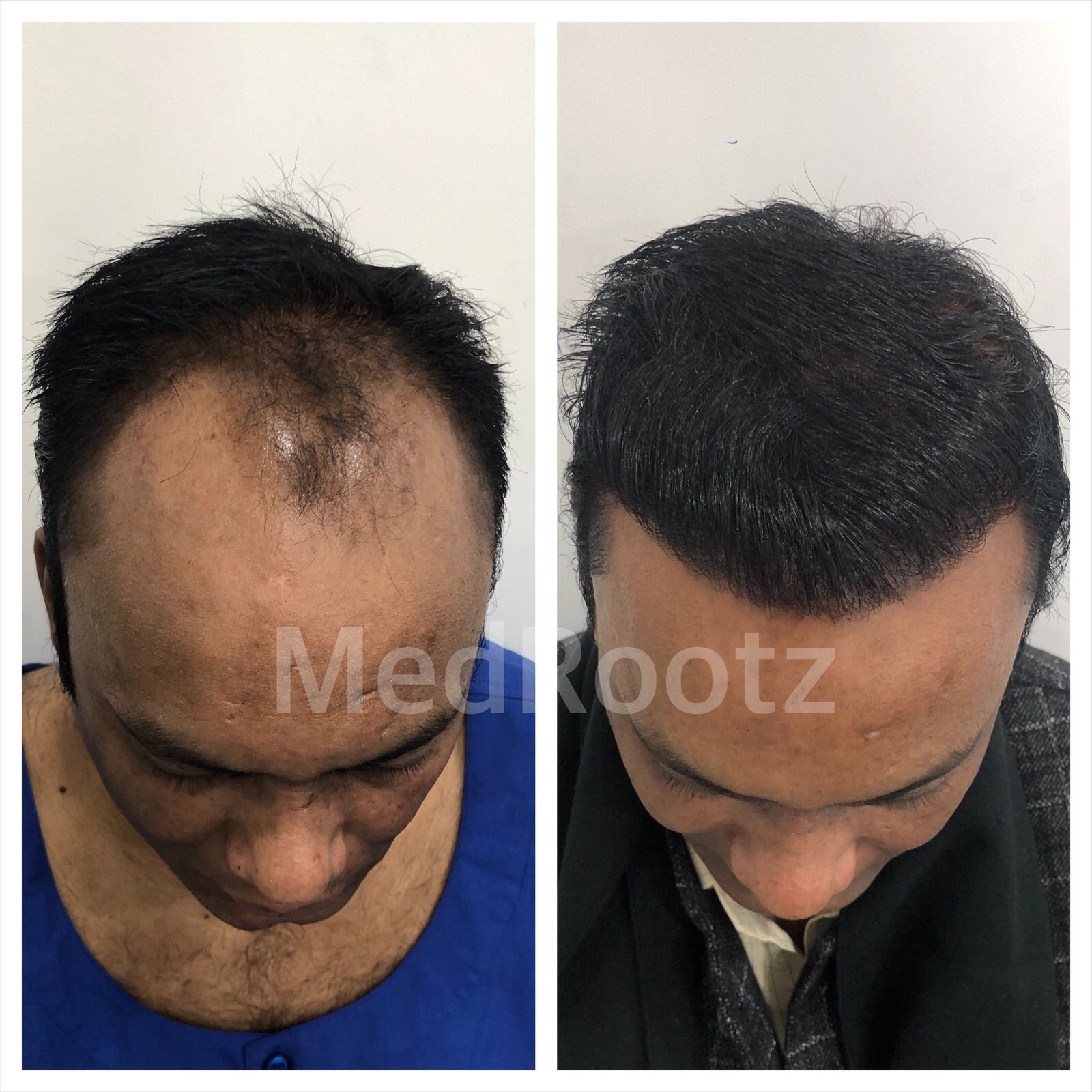 Best Hair Transplant in Delhi, India at the Best Hair Clinic in Delhi -  MedRootz