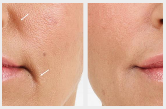 Dermal Fillers