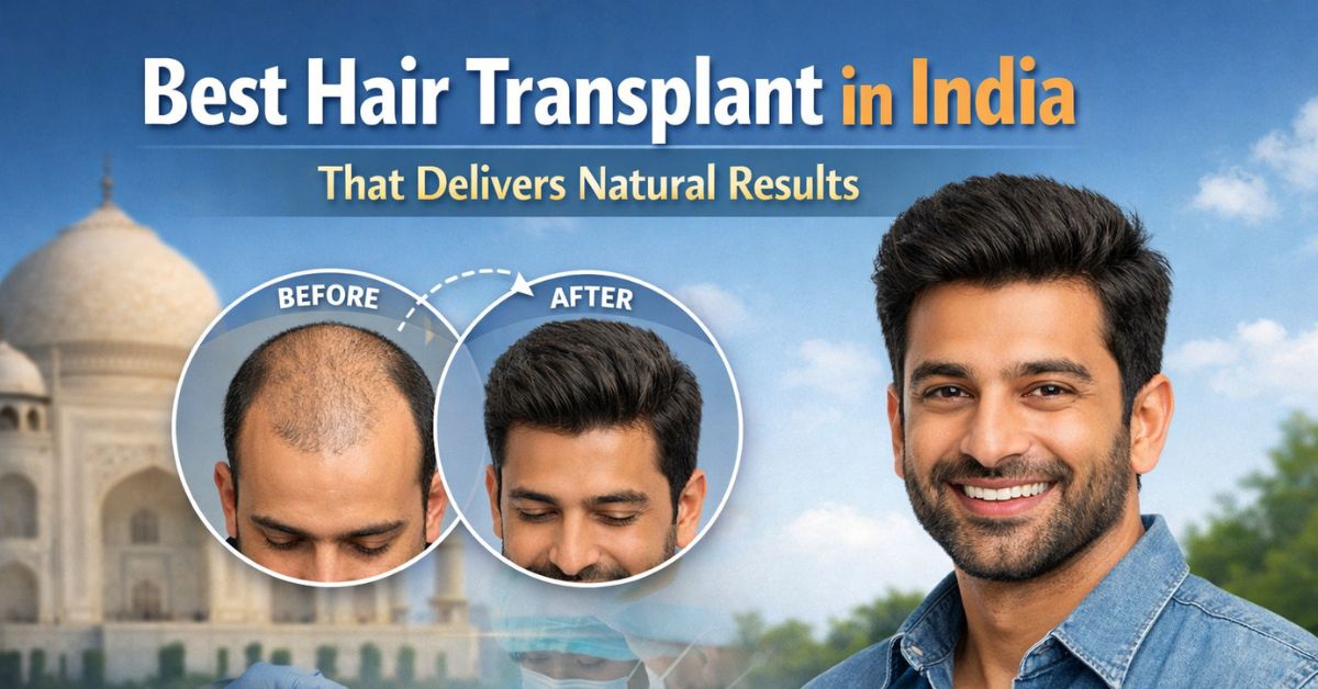 Best Hair Transplant in Delhi