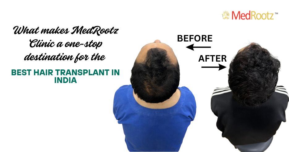 Best Hair Transplant in India